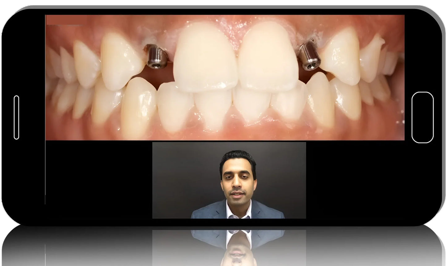 Digital Driven Implant Planning