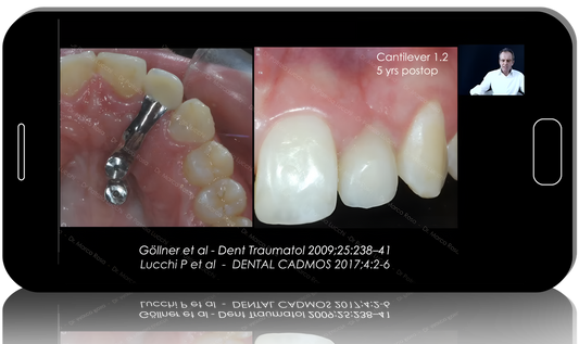 Missing maxillary lateral incisors: space closure in all malocclusions vs implants and prosthetic replacement